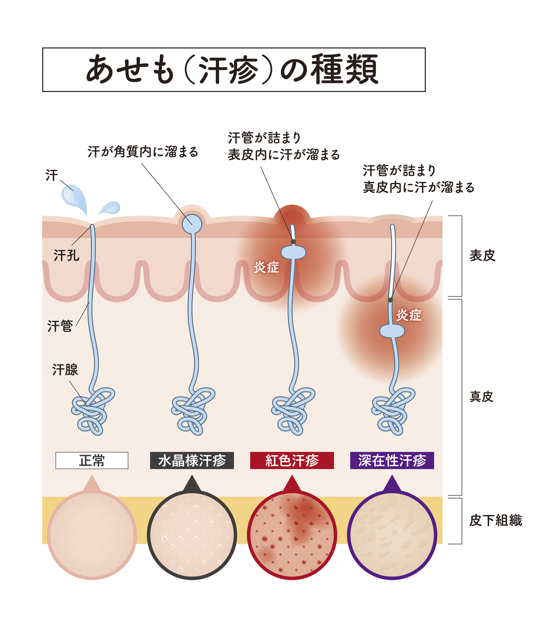 あせも（汗疹）の種類を示す皮膚断面図。正常・水晶様汗疹・紅色汗疹・深在性汗疹の4種類を、表皮・真皮・皮下組織の層ごとに比較したイラスト。